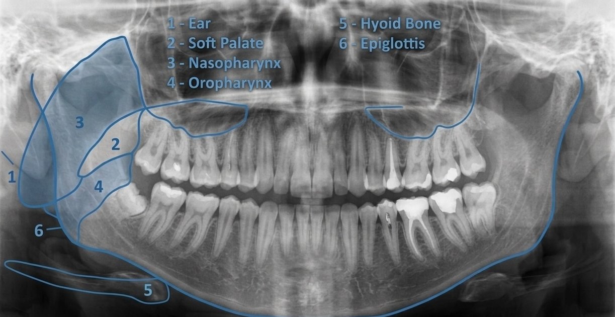 Panoramic dental radiograph with the collateral anatomy labelled